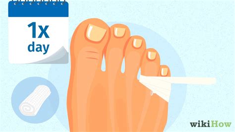 how to treat a stubbed pinky toe